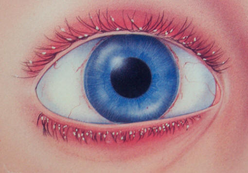 Blepharitis โ eyelid margin inflammation