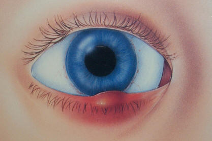 Chalazion โ meibomian gland cyst complication of blepharitis