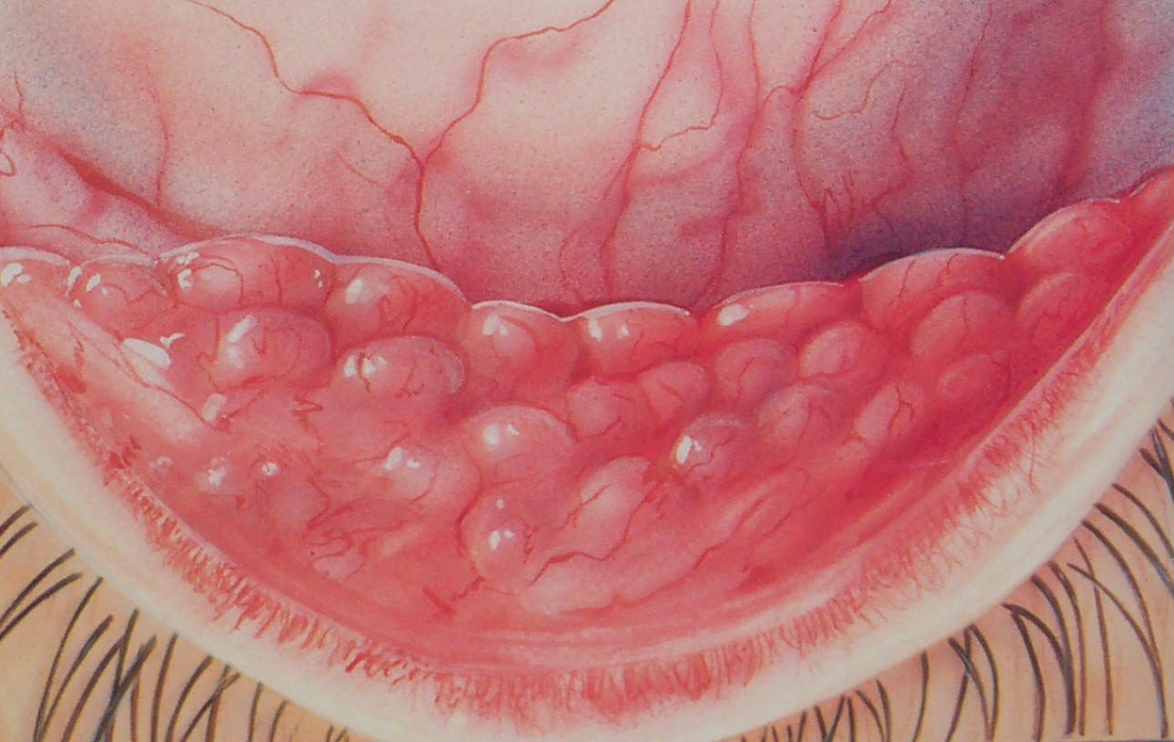 Viral conjunctivitis โ differential diagnosis