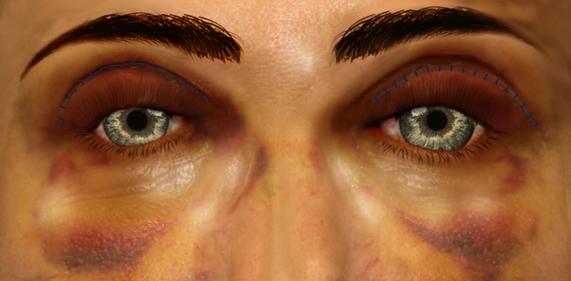 Upper blepharoplasty recovery at 1 week