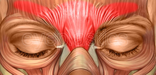 Standard botulinum toxin injection sites diagram