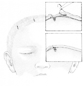 Endoscopic brow lift — complete