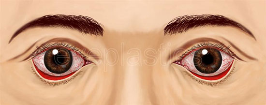 Clinical photograph of ectropion — lower eyelid turning outward