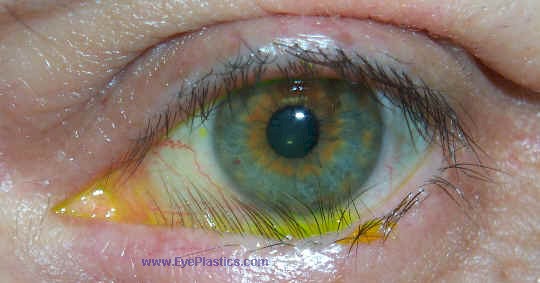 Clinical photograph of trichiasis — eyelashes rubbing on the cornea
