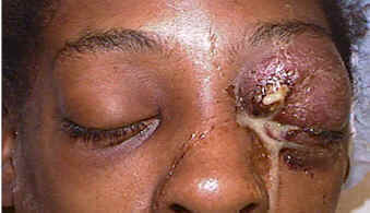 Herpes zoster ophthalmicus — dermatomal rash involving the forehead and eyelid