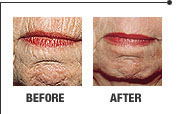 Laser skin rejuvenation result 6
