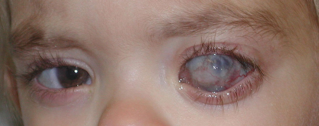 Blind, painful left eye due to advanced, congenital glaucoma