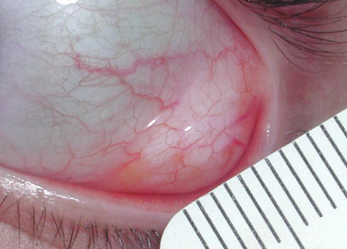 Orbital Tumors - Dermoids Compare with EPIDERMOID